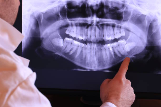 Best Emergency Wisdom Teeth Removal in Edgewood, FL